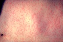 Measles Problen Continues in Rockland, Exposure Reported at Mall & East Ramapo Grammar School