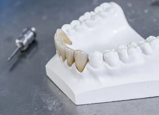 Difference Between Digital And Traditional Impressions In A Dental Lab