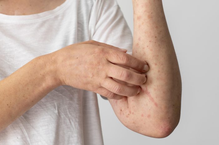 Measles Case Confirmed in Rockland